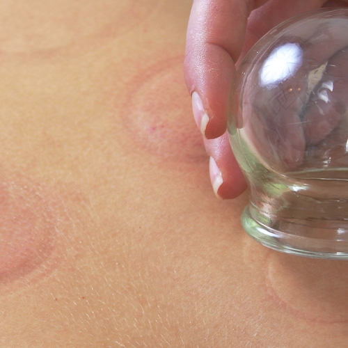 physical-therapy-clinic-cupping-advanced-care-physical-therapy-edison-milltown-nj